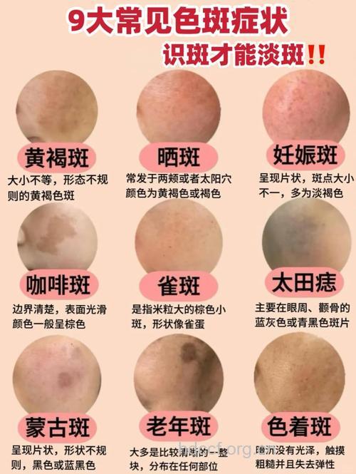 色斑的症状图片