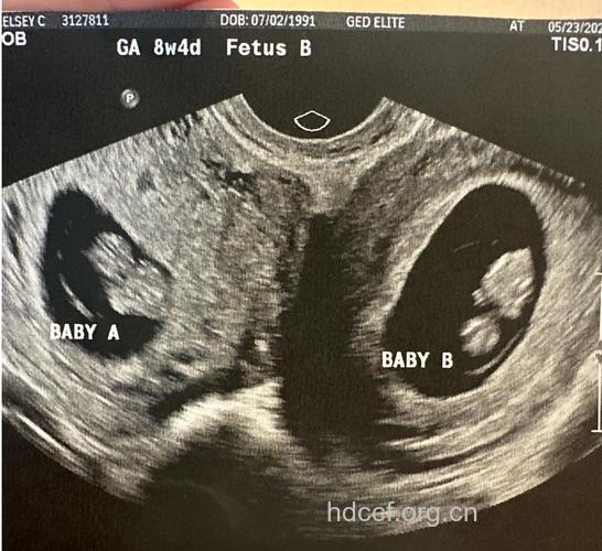 女性流产前需做B超检查