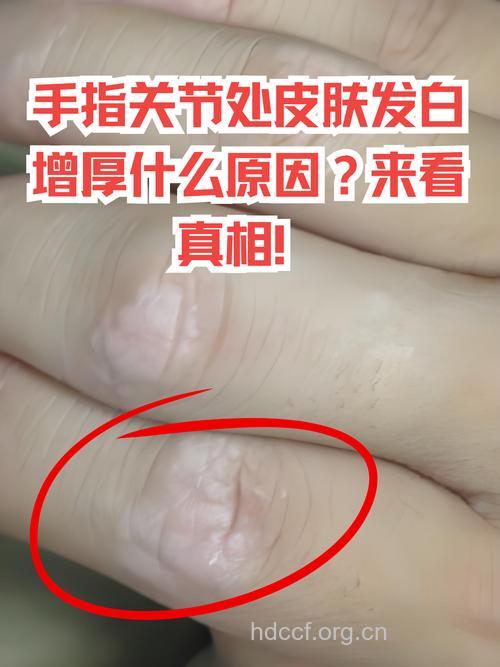 男性手指有白斑可能肾虚