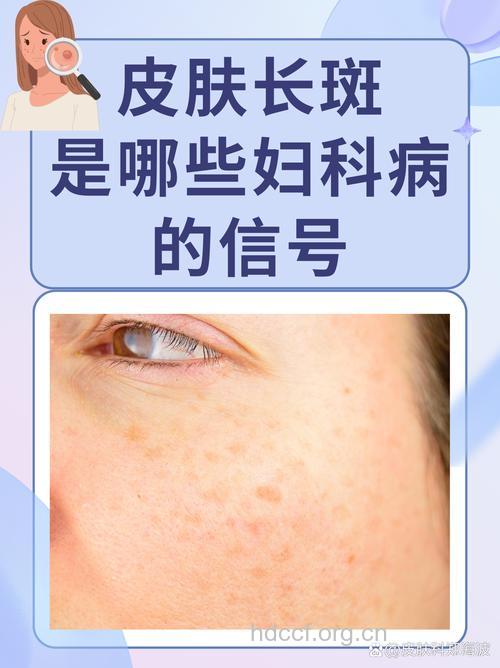 脸上长斑 小心妇科病