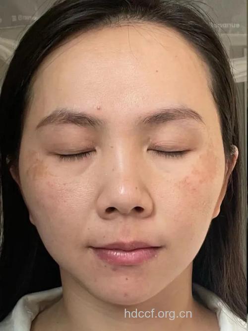 黄褐斑患者要怎么化妆