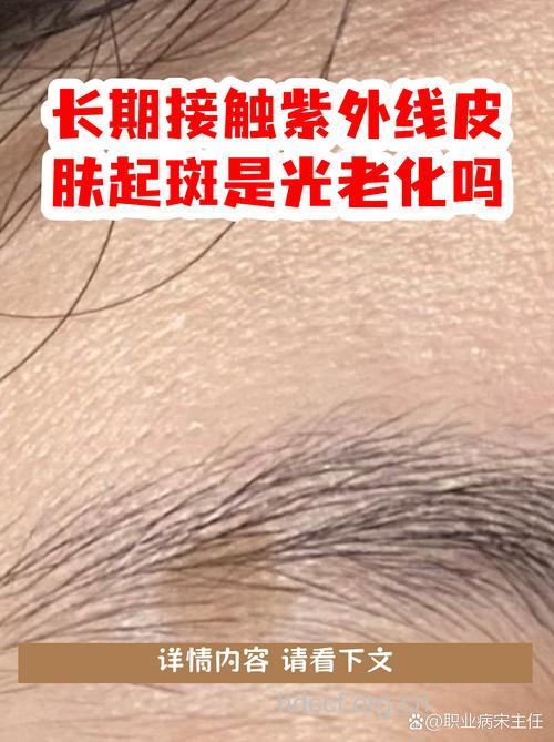 紫外线照射易引发色斑