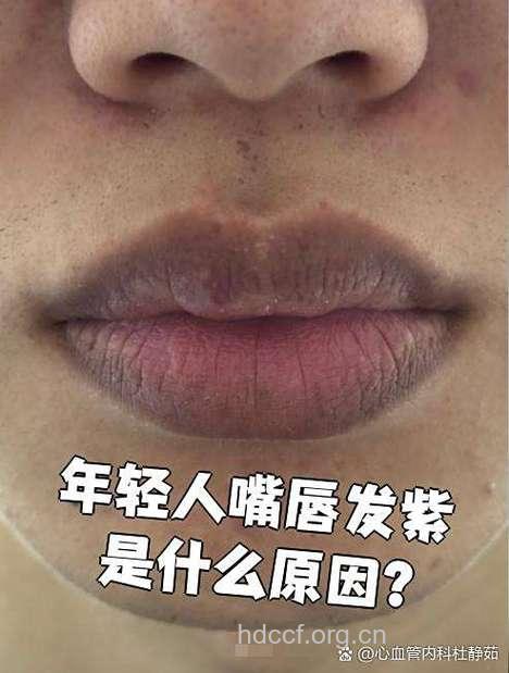 嘴唇发紫是为什么
