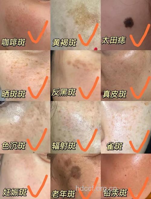 女人 这五个时期易长斑