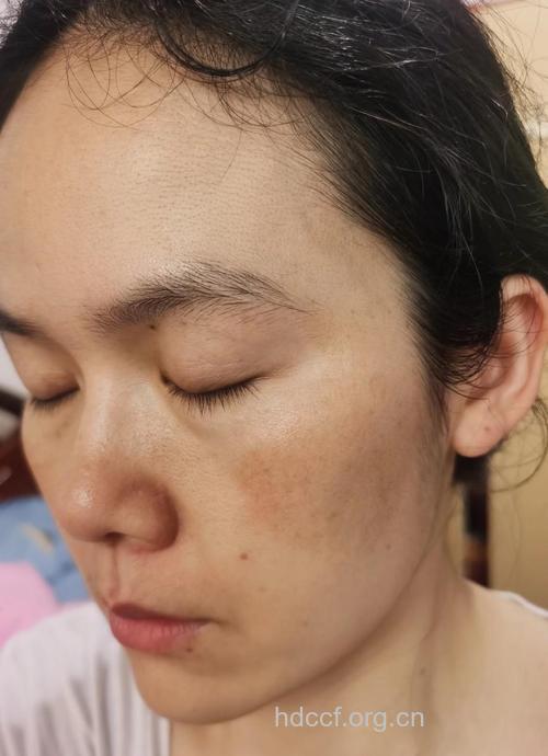 黄褐斑有哪些明显的症状表现