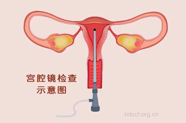 宫腔镜