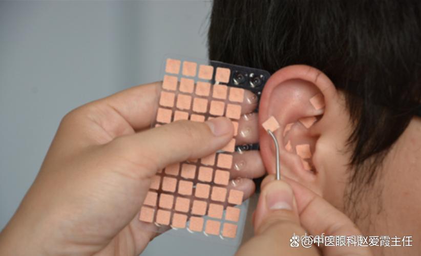 耳针疗法可以淡化黄褐斑吗