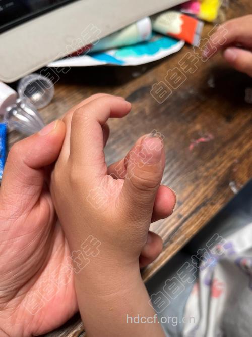 小儿虎口纹该怎么看?