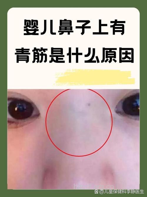 小儿鼻根有青筋是怎么回事