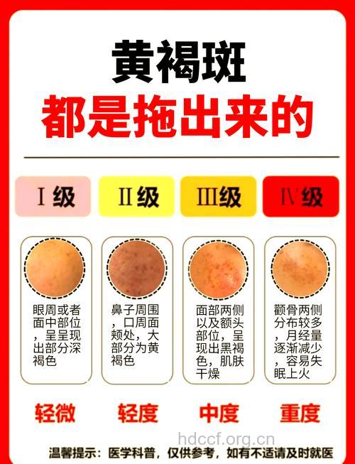 治疗黄褐斑的方法有哪几种