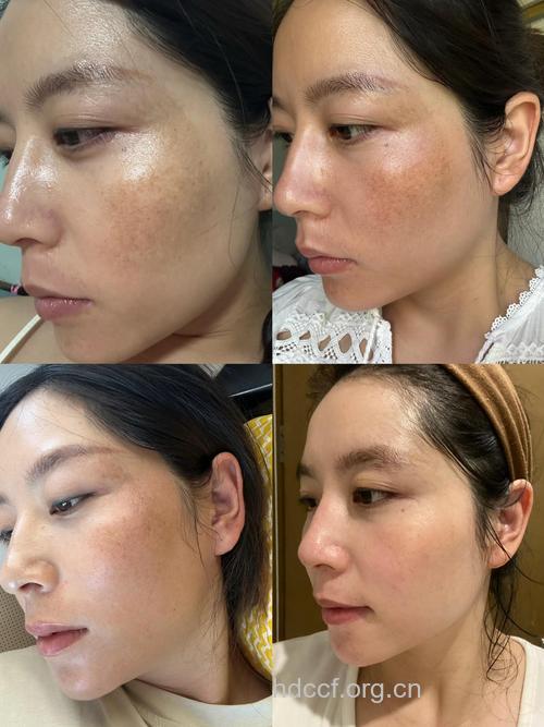 激光治疗黄褐斑效果怎么样