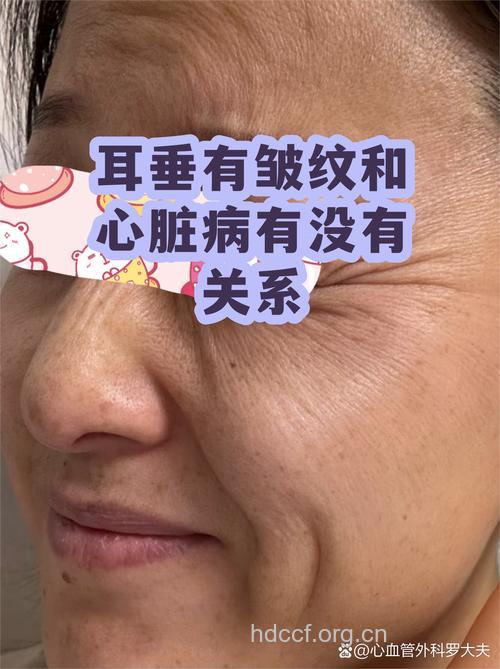 耳垂出现皱纹可能是心脏病的征兆