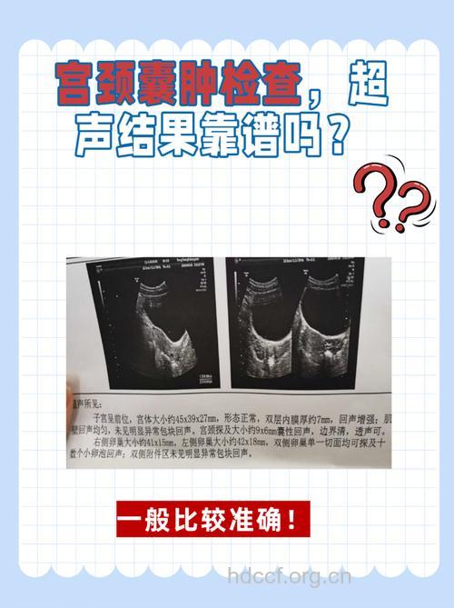 诊断女性卵巢囊肿要做哪些检查？