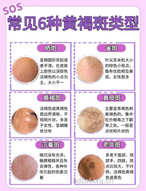 黄褐斑的成因到底是哪些