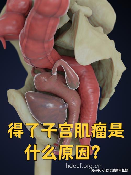 惊!她体内潜藏78枚子宫肌瘤