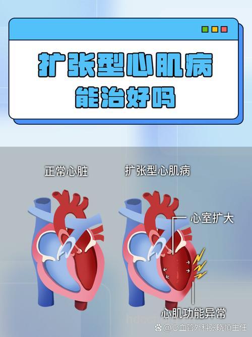 女性扩张型心肌病不宜妊娠