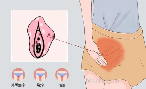 外阴瘙痒可能是炎症在作祟