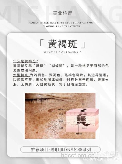 化妆品会不会引起黄褐斑