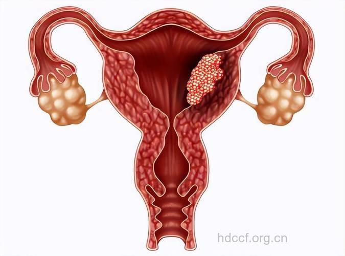 不洁性交诱发女性宫颈癌
