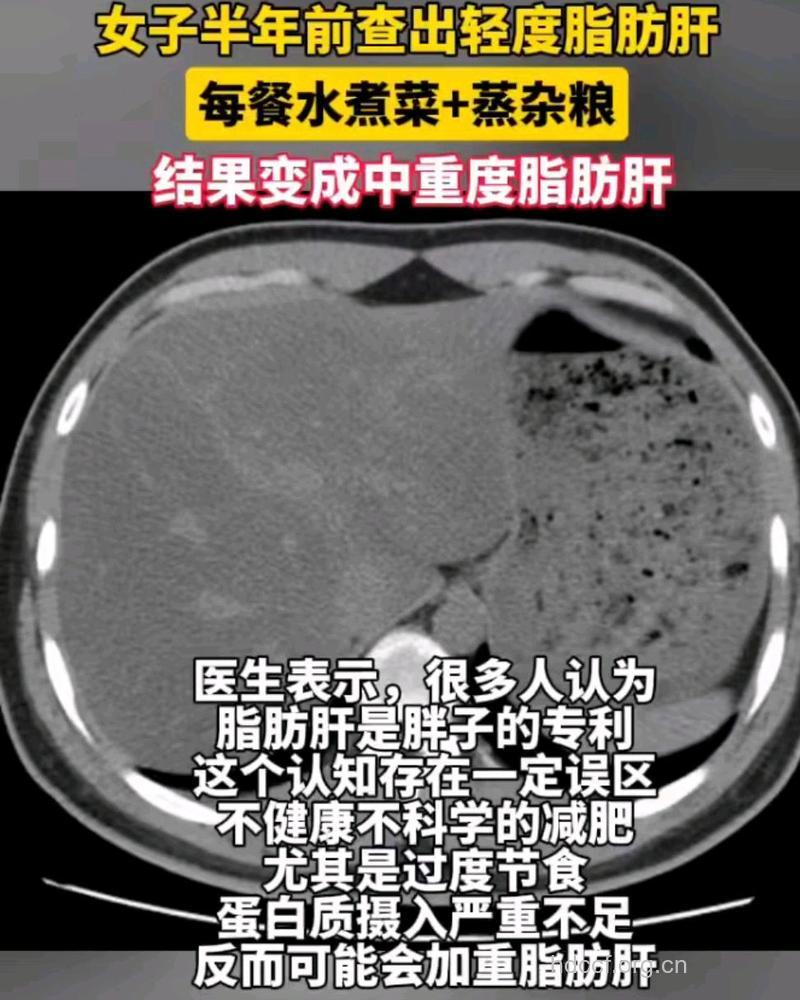 惊!吃素减肥竟被查出脂肪肝