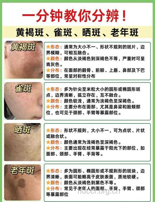 黄褐斑是由哪些原因形成的