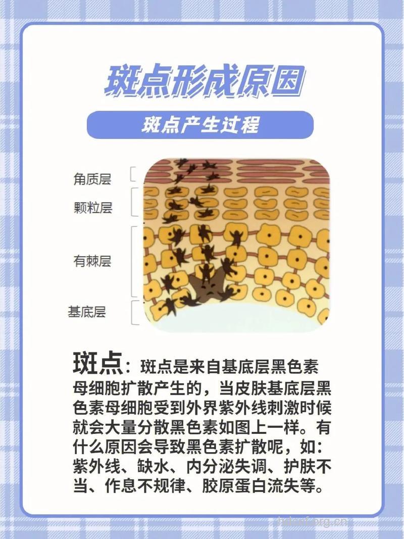 黄褐斑的形成要素
