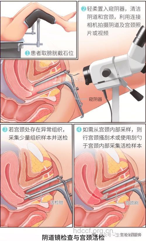 阴道镜检查 女人必做的检查
