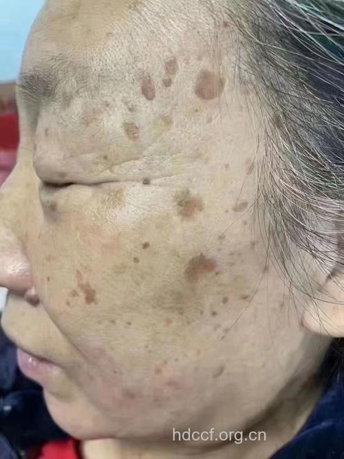 老年斑不是“小菜一碟”
