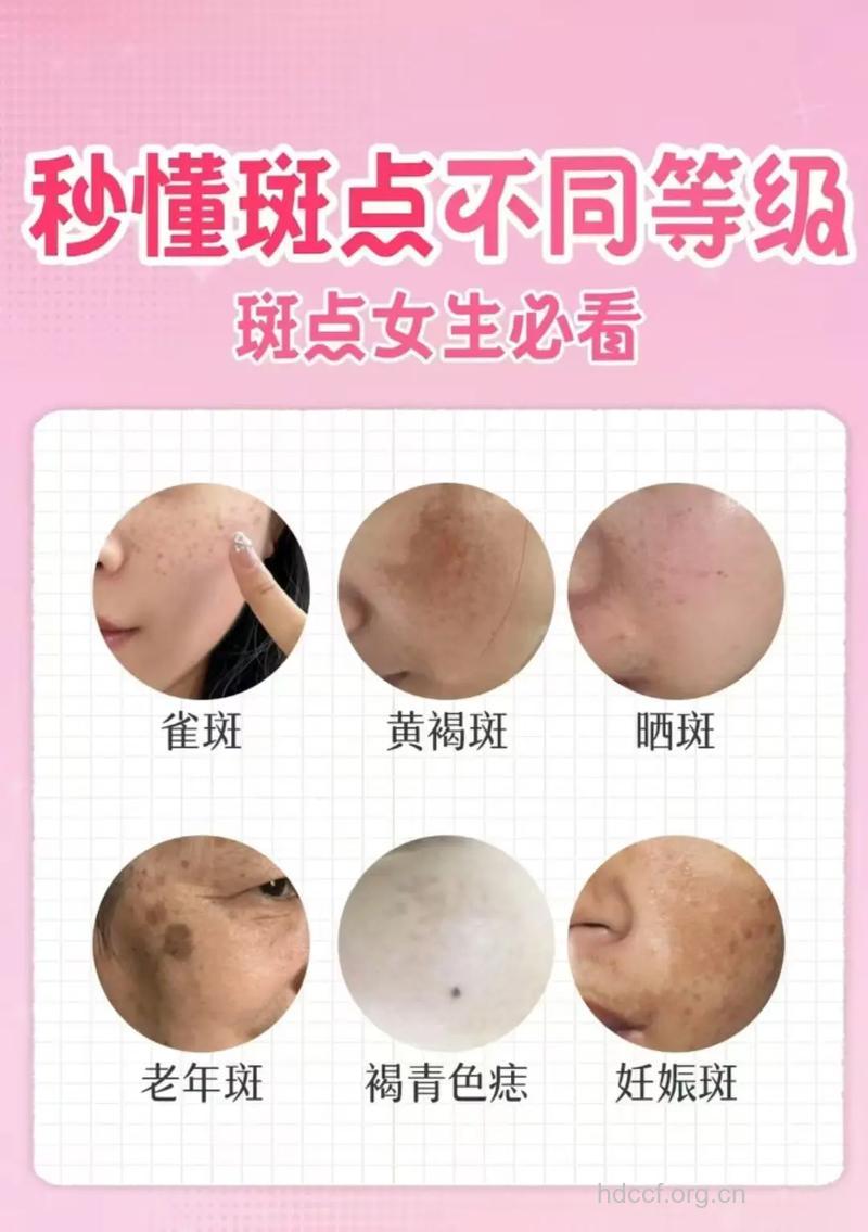 解析可爱的雀斑