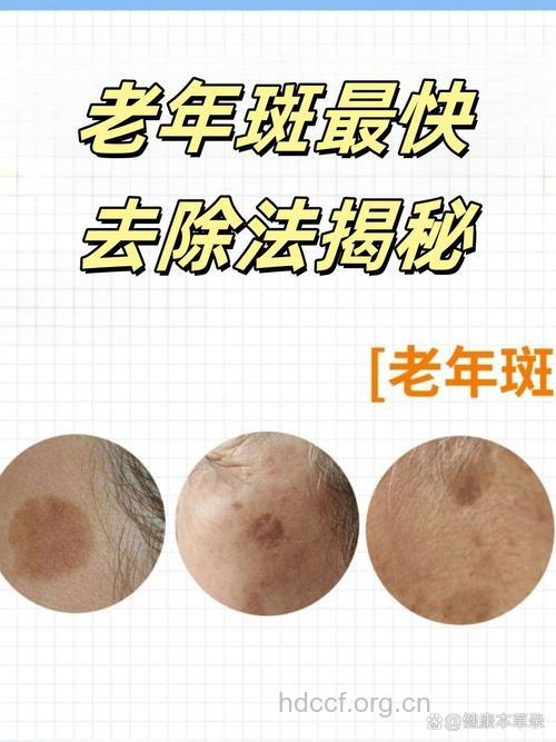 维生素E“吃”掉老年斑