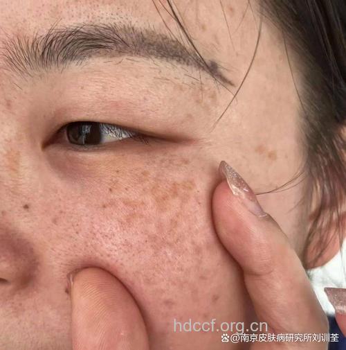 太阳又惹祸 多晒雀斑多