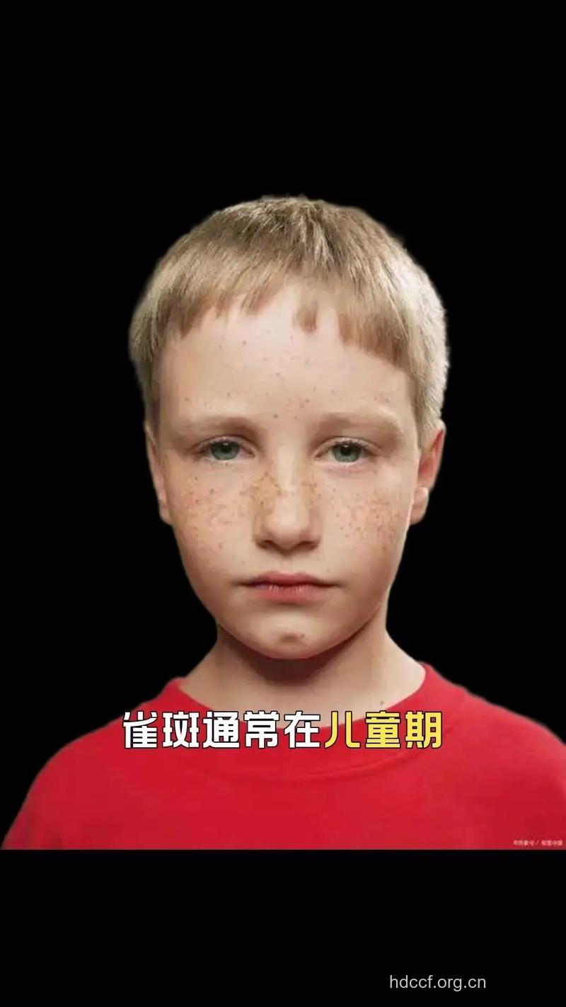 雀斑致病基因已确定