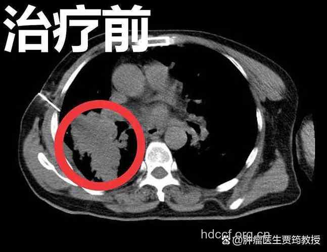 CT检查会增加患癌风险吗?