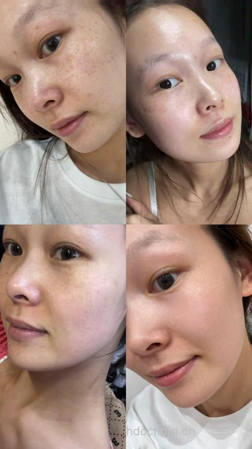 想祛斑 不是简单的面子工程啊