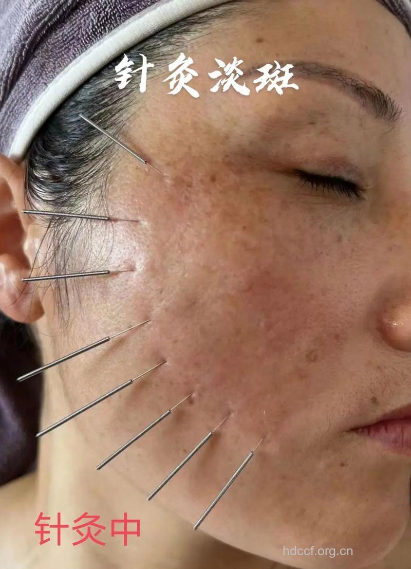 中医针灸治疗黄褐斑