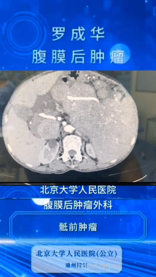 经常接触有机玻璃,竞得腹膜恶性肿瘤