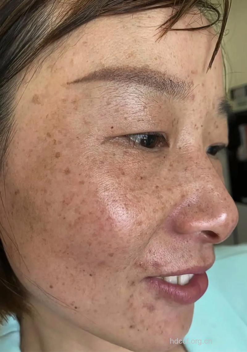 怎样做一个无斑的女人