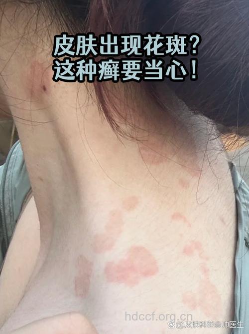 花斑癣的表现与分型