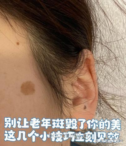 你还打算让色斑欺负多久?