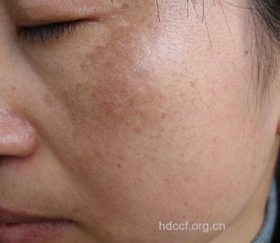 黄褐斑有哪些临床表现