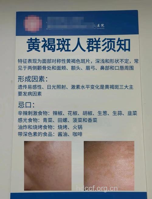 哪些病因会形成黄褐斑