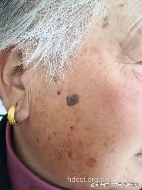 老年斑猛长有什么危害
