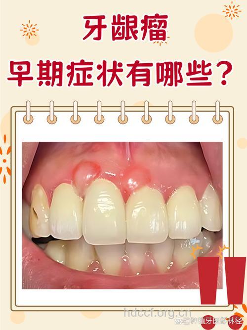 惊:牙齿也会长肿瘤