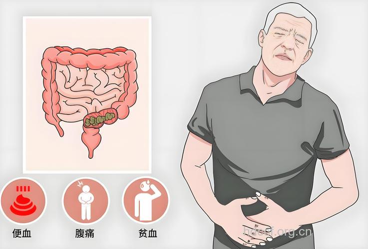 便秘或腹泻,小心肠癌