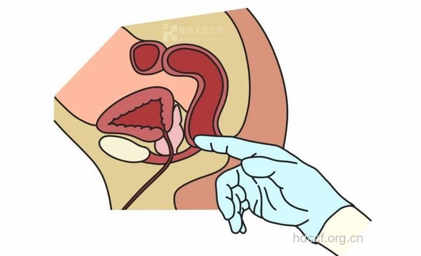老人为什么要进行肛门指检