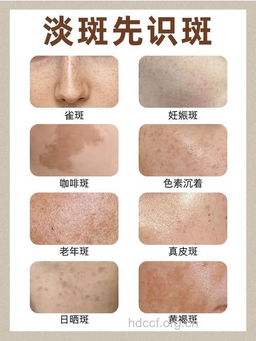 有哪些常见面部色斑种类