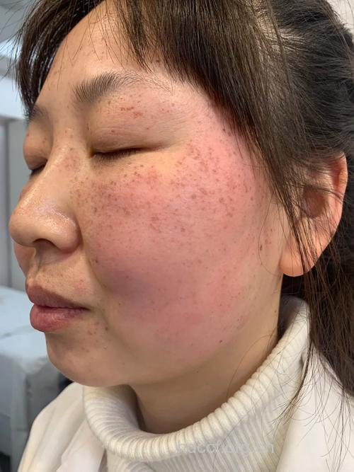 色斑成为中国女性的皮肤杀手