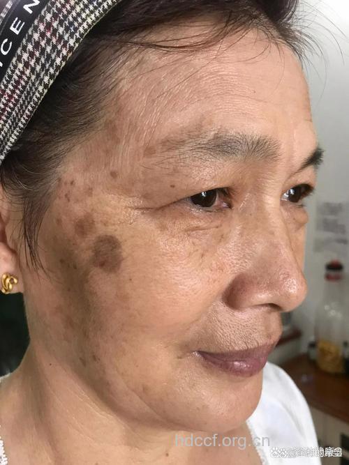 老人脸上的色斑揭示健康