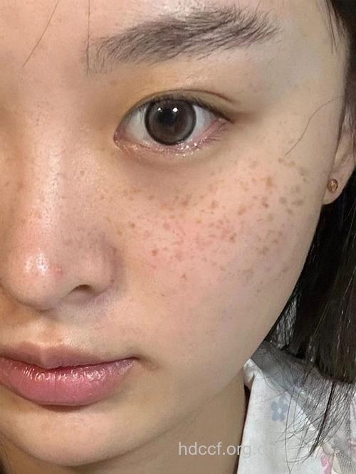 面部色斑显示女人健康