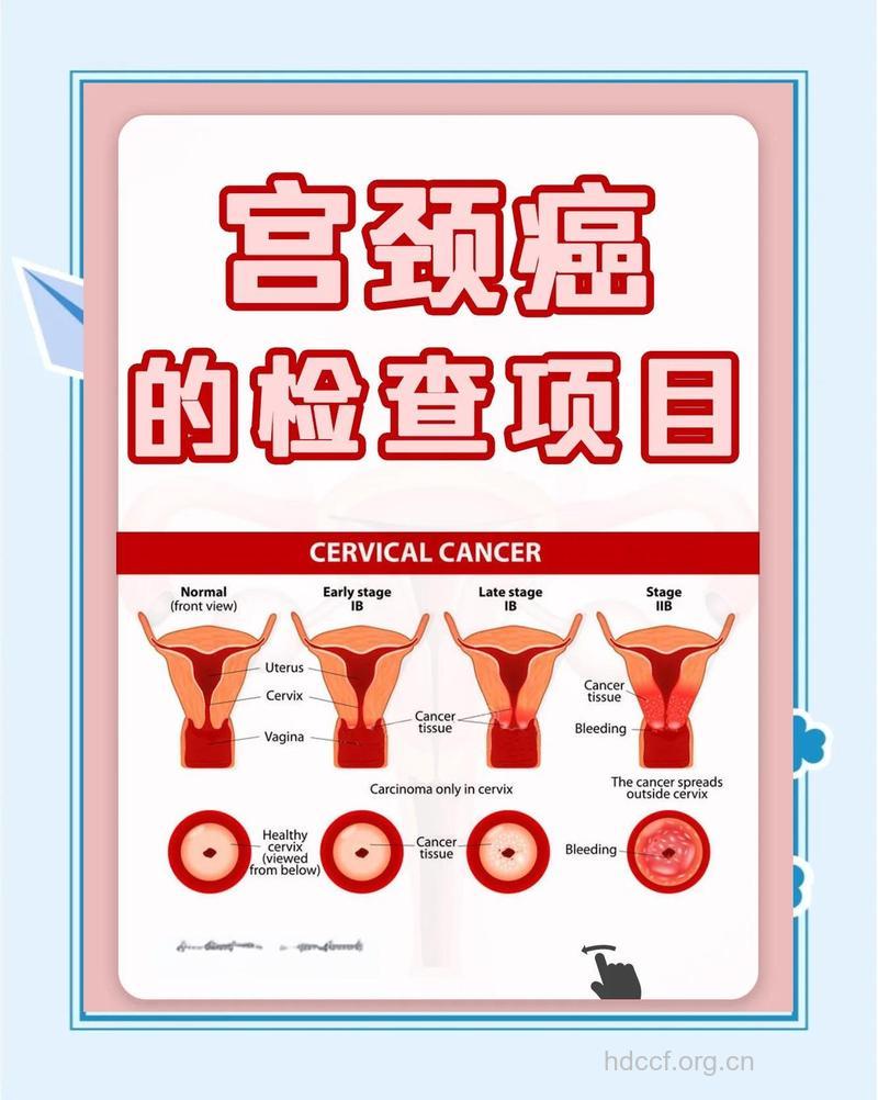 30岁上女性需定期查宫颈癌